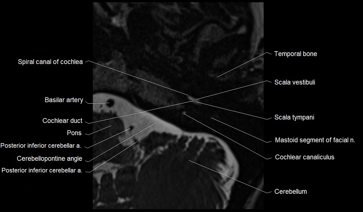 Internal auditory canal (IAC) axial cross sectional anatomy image 3.webp
